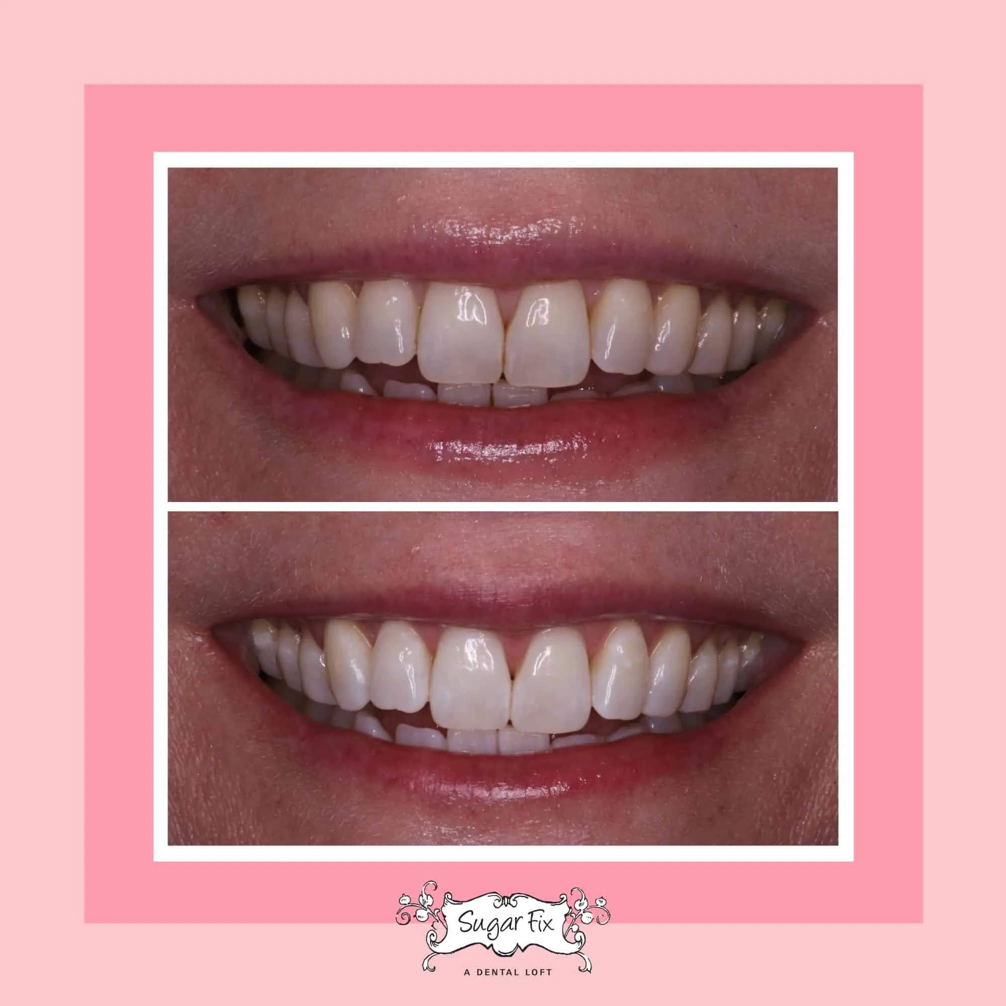 31453 in office teeth whitening