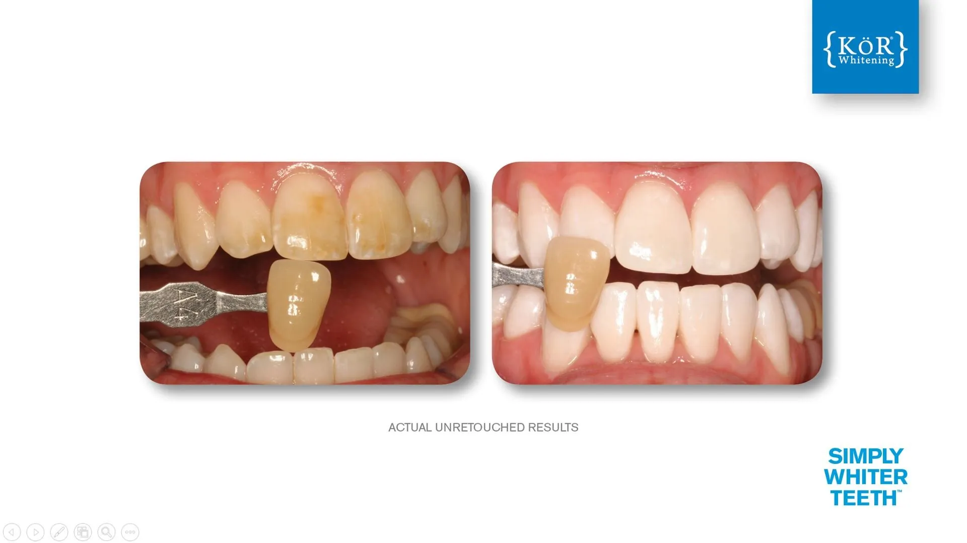 31453 teeth whitening cost