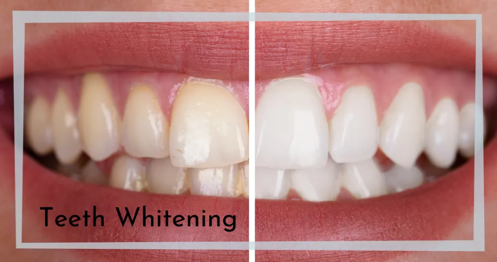 31453 teeth whitening diet