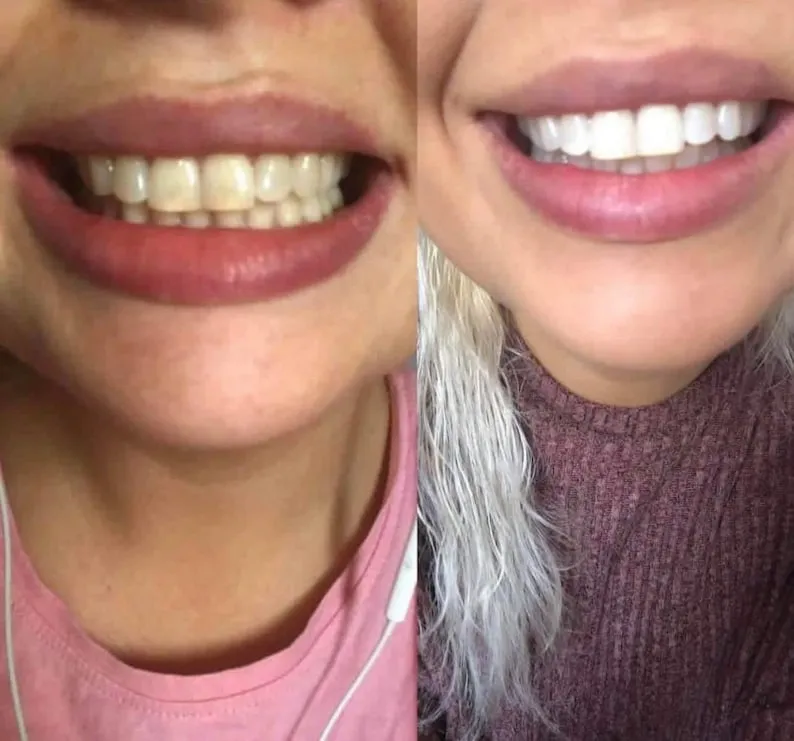 31455 professional teeth whitening
