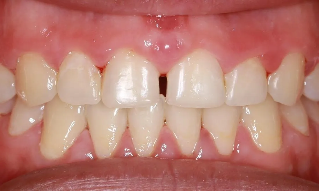 31460 fluorosis teeth