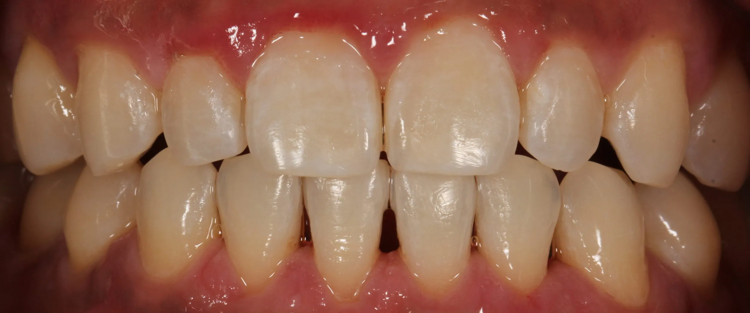 31460 teeth whitening procedure