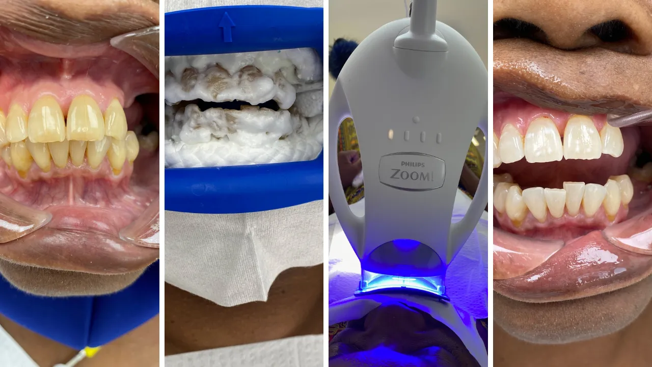 31461 zoom teeth whitening diet