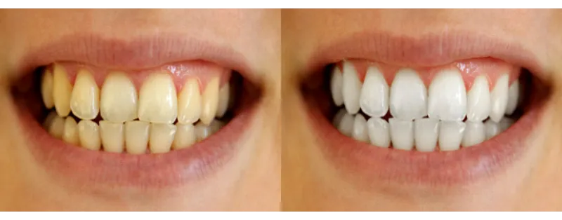 31461 zoom teeth whitening process