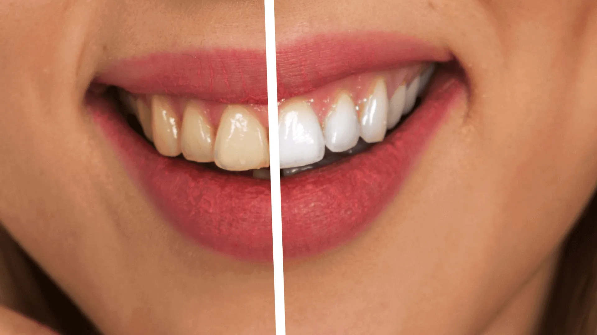 /img/31461-zoom-teeth-whitening-results.webp