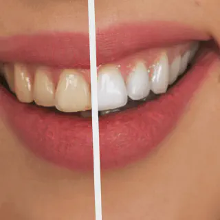 /img/31461-zoom-teeth-whitening-results.webp