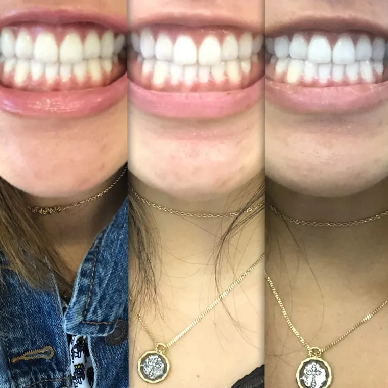 31471 teeth whitening before after