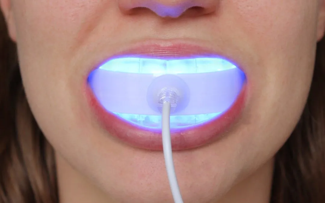 31471 uv light teeth whitening