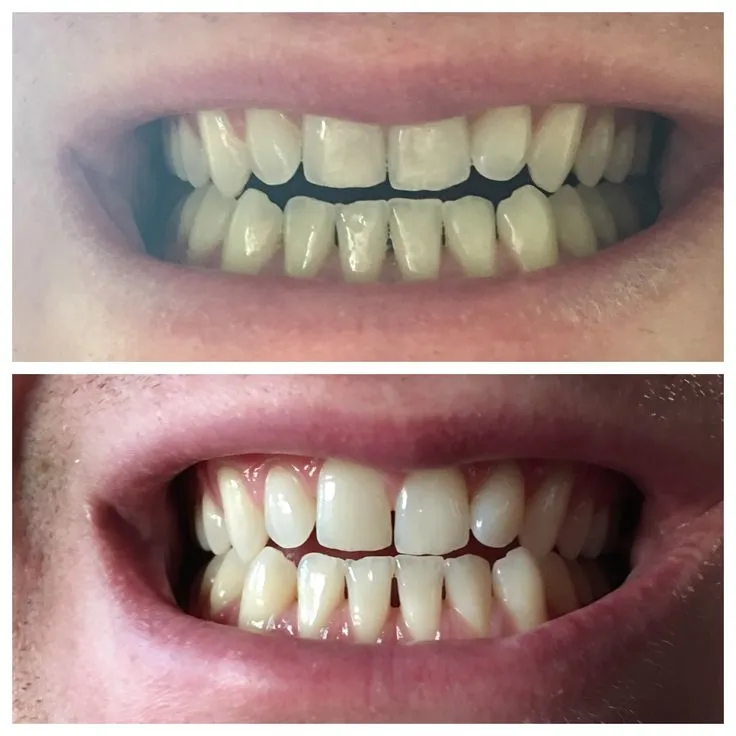 31473 burst whitening strips promo code 4