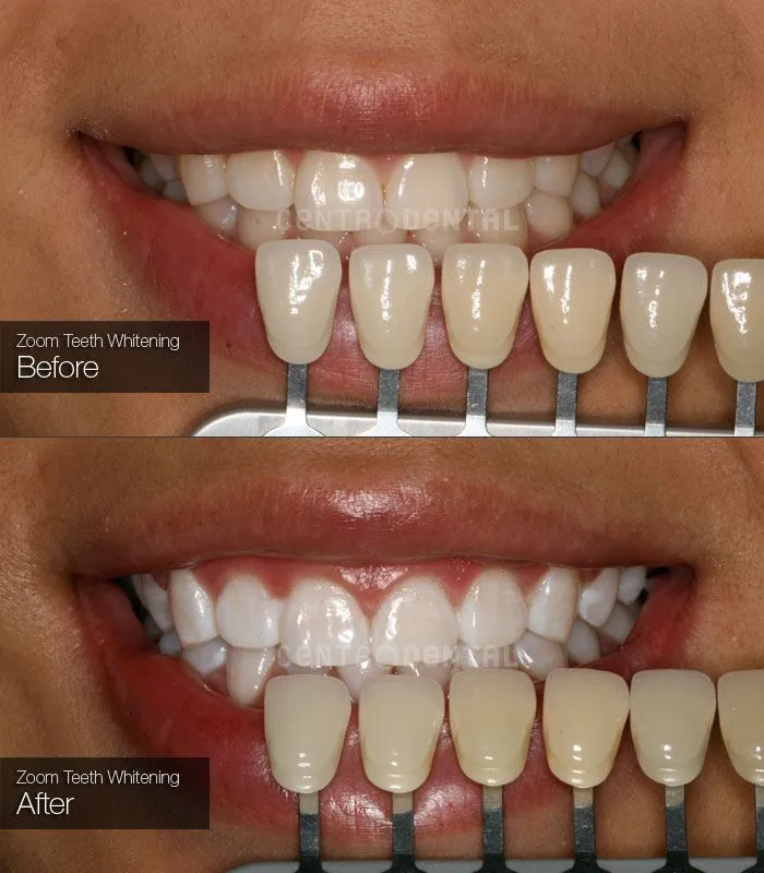 31479 zoom teeth whitening before after