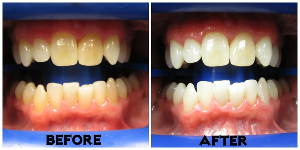 31479 zoom teeth whitening comparison