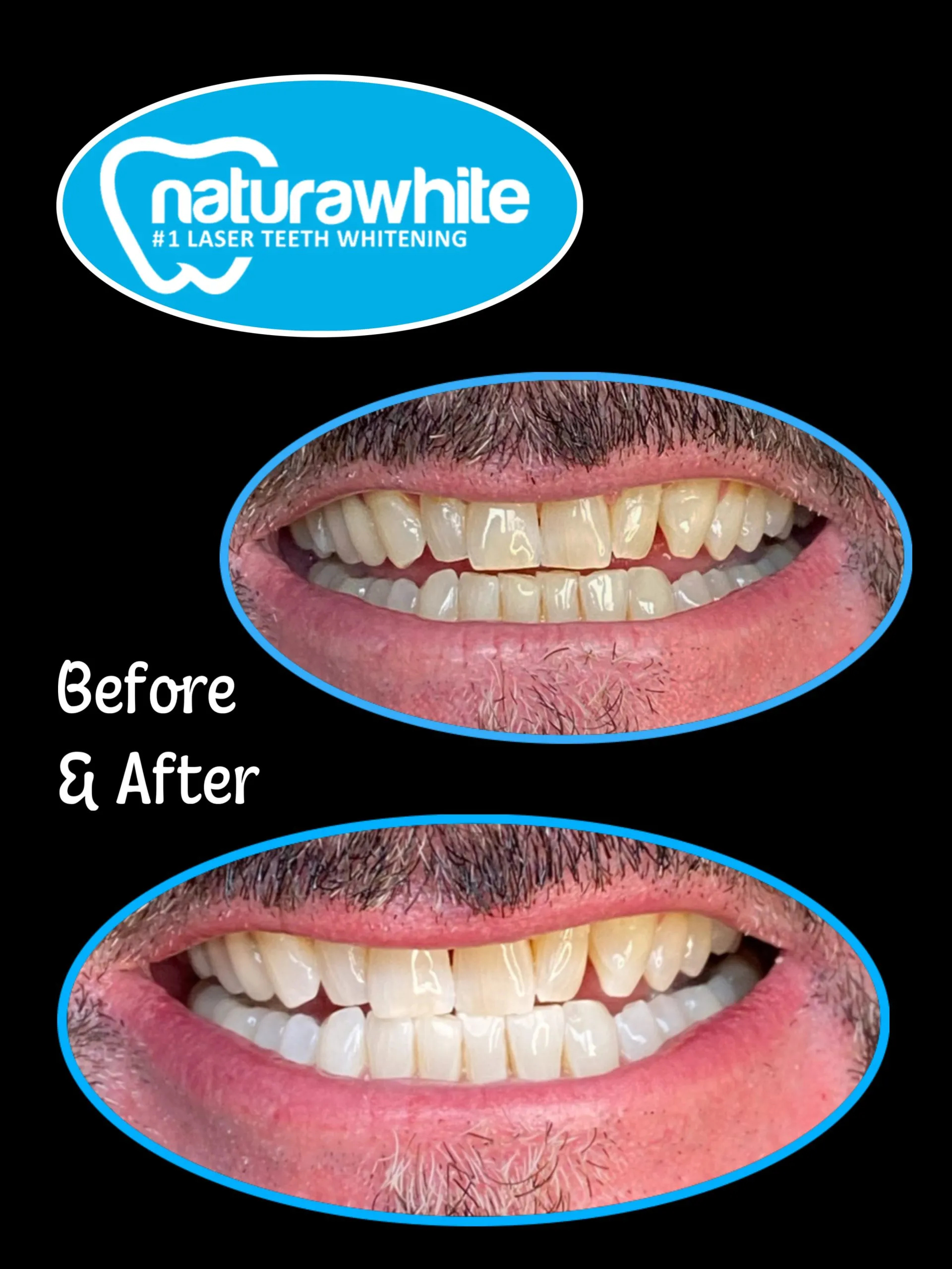 31480 laser teeth whitening bristol clinic