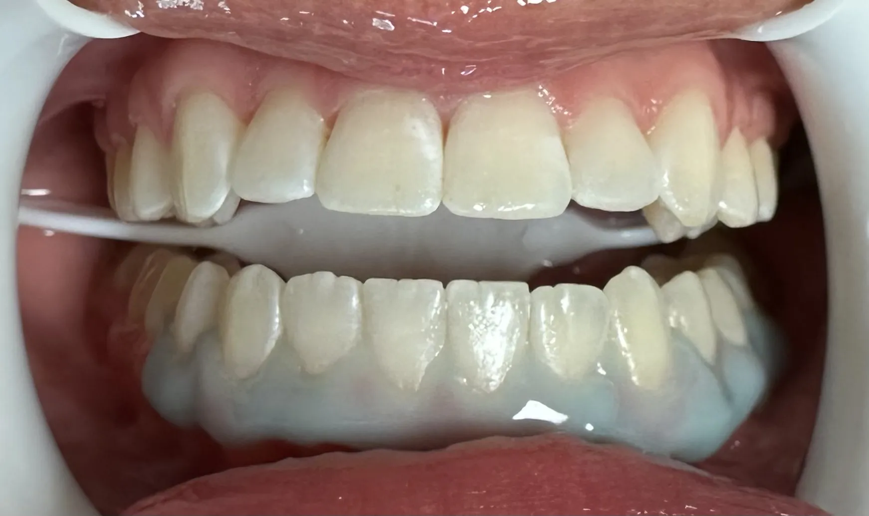 31483 glo whitening cycle