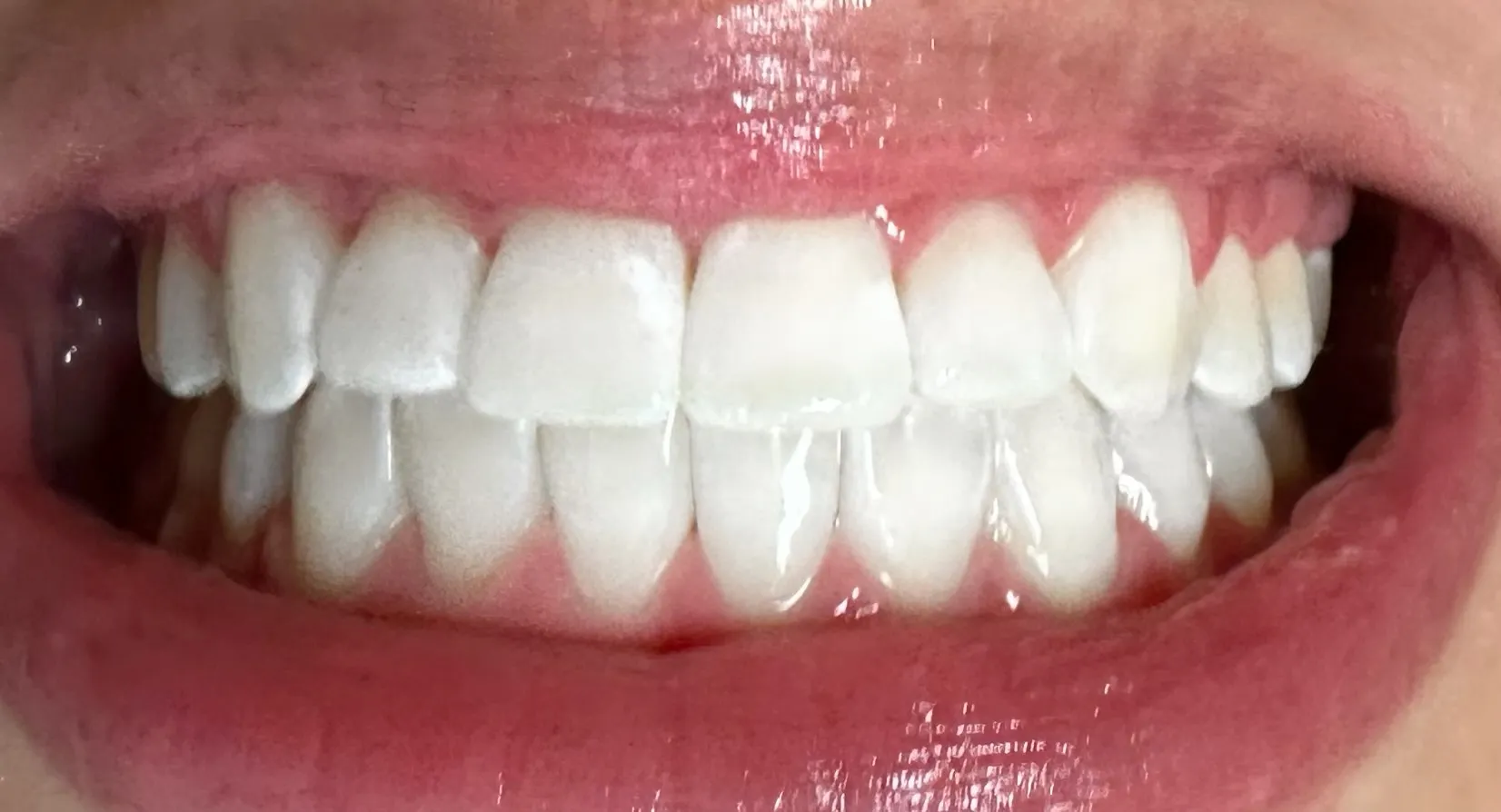 31483 whitening gel application
