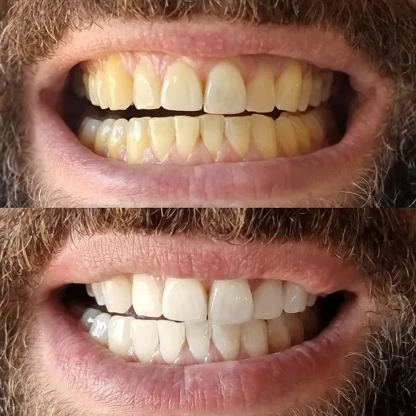31490 teeth whitening procedure
