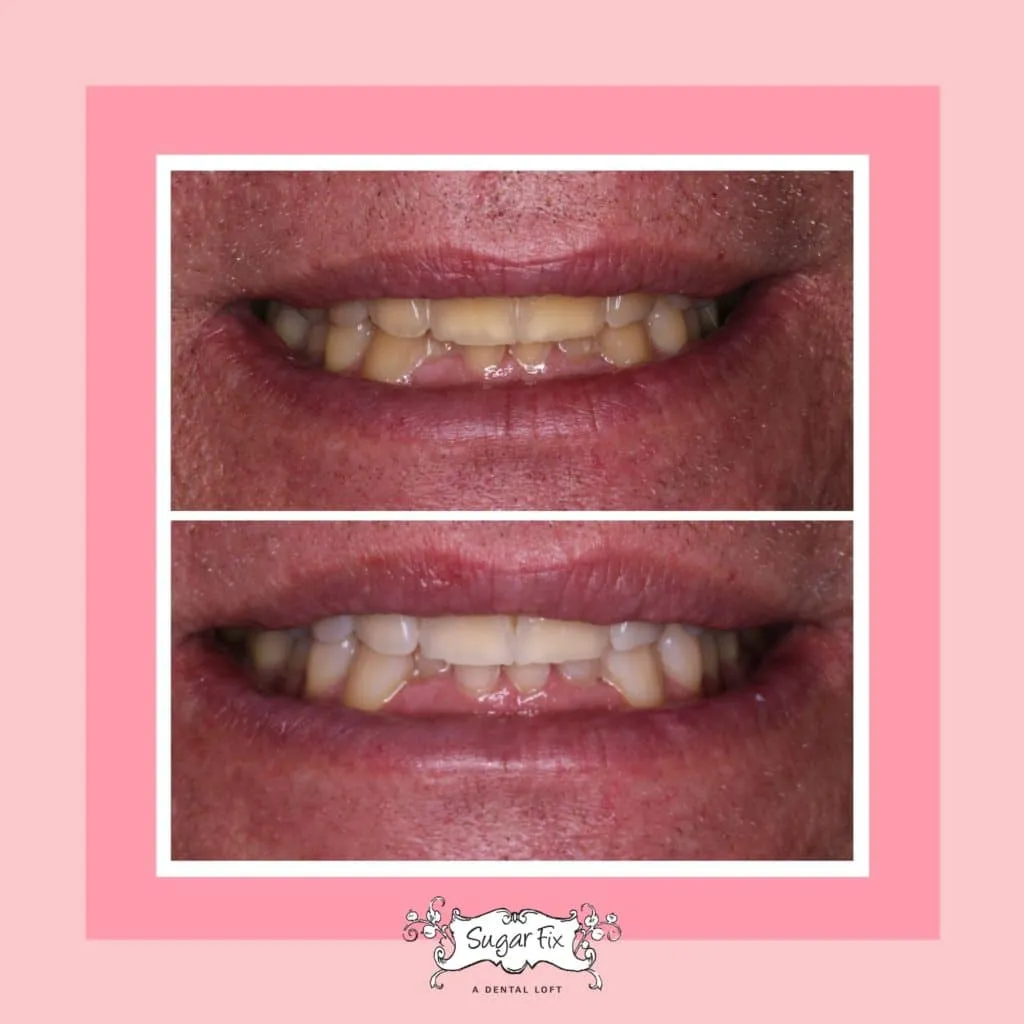 31492 take home teeth whitening kits illinois