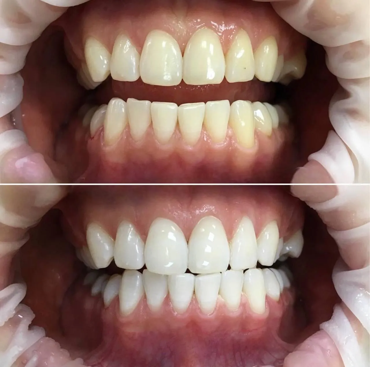 31492 teeth whitening strips illinois