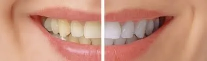 31502 teeth whitening glendale az 4