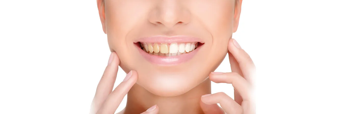 31511 teeth whitening springfield cost