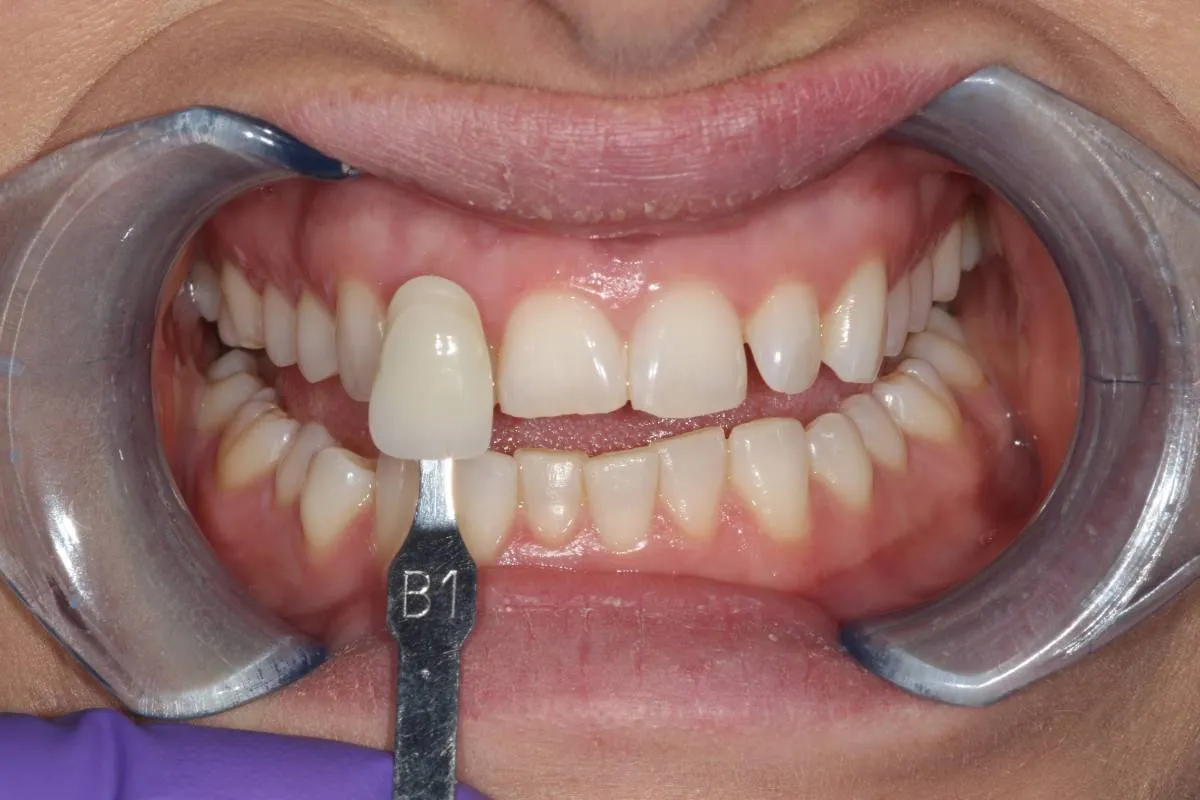 31518 teeth whitening diet 5