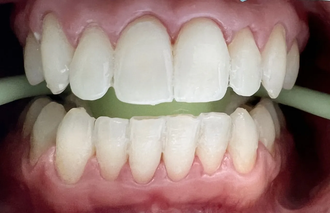 31524 enhanced enamel protection