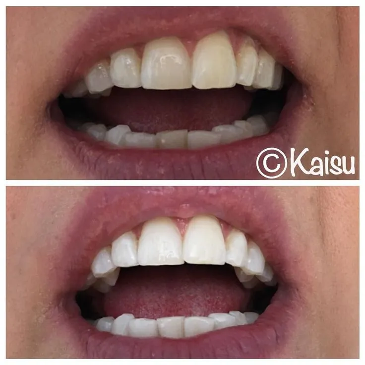 /img/31524-teeth-whitening-comparison.webp