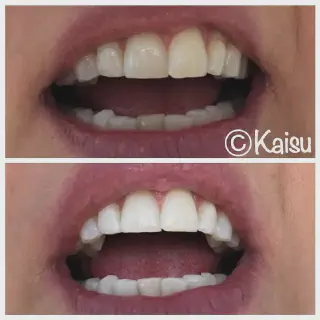 /img/31524-teeth-whitening-comparison.webp
