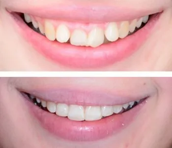 31526 at home teeth whitening kit