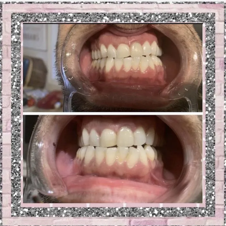 31529 amour teeth whitening long lasting results
