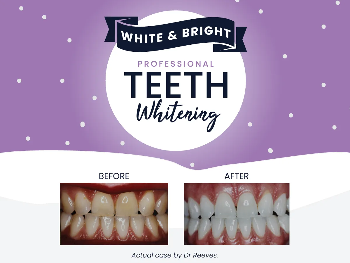 31530 gaoc teeth whitening procedure