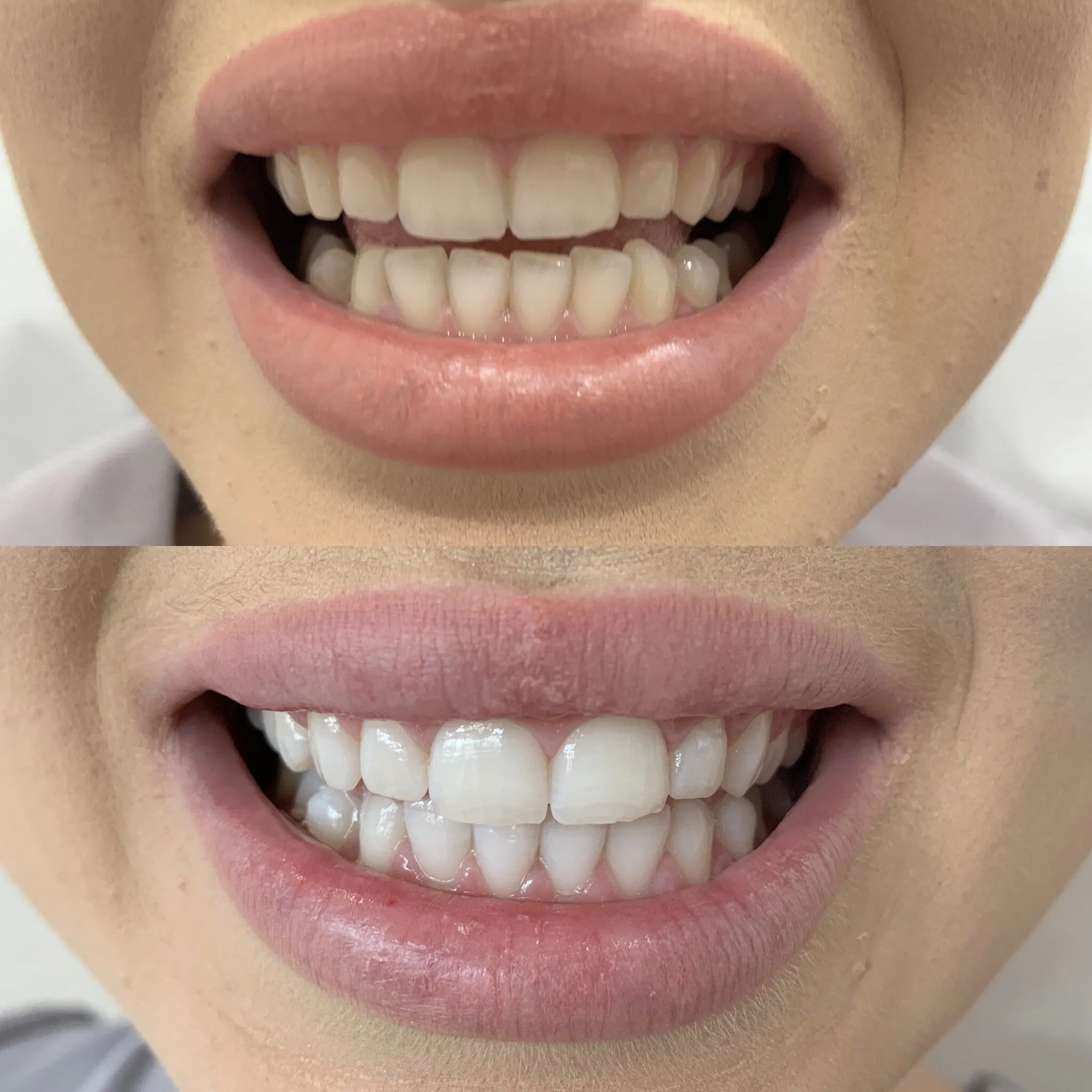 31530 teeth whitening confidence