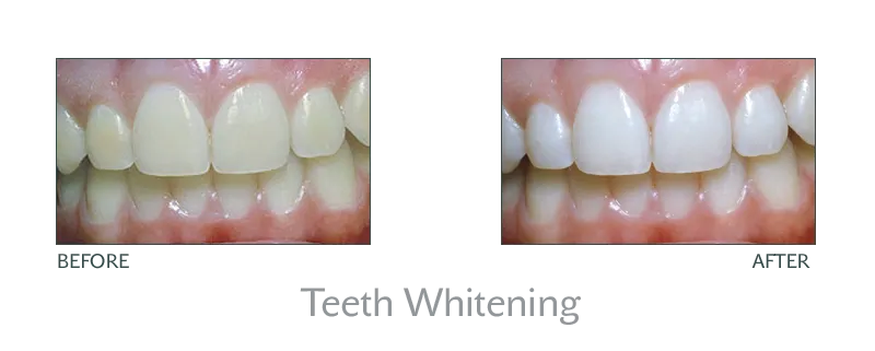 31531 in office teeth whitening