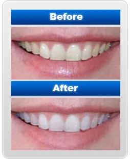 31531 teeth whitening maintenance