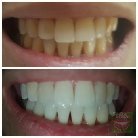 31533 teeth whitening philippines clinic