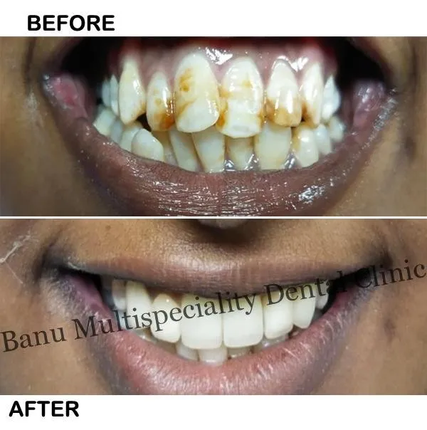 31536 at home teeth whitening blackrock