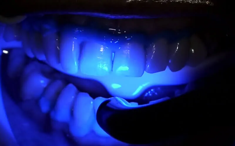 31536 teeth whitening aftercare blackrock