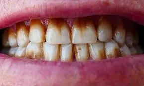31536 teeth whitening blackrock before after