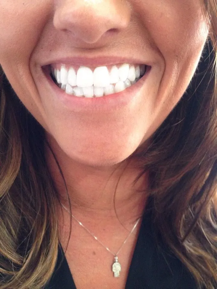 31536 teeth whitening cost blackrock