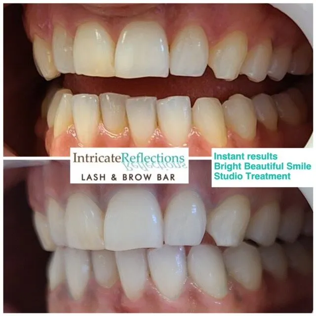 31536 teeth whitening options blackrock