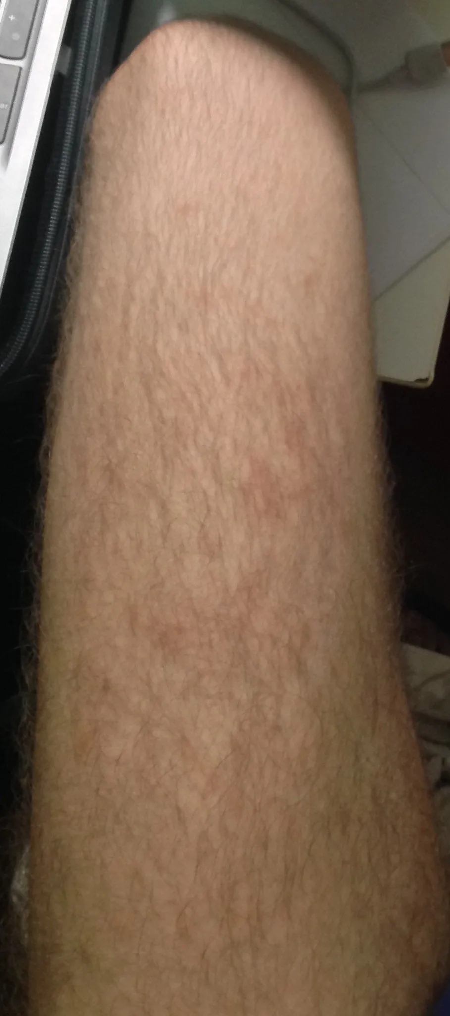 31540 skin discoloration