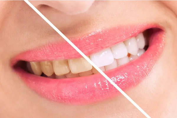 /img/31541-teeth-whitening-review.webp