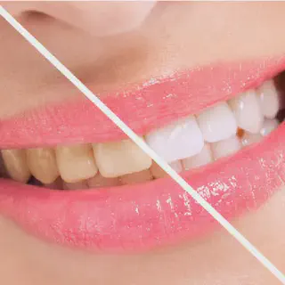 /img/31541-teeth-whitening-review.webp