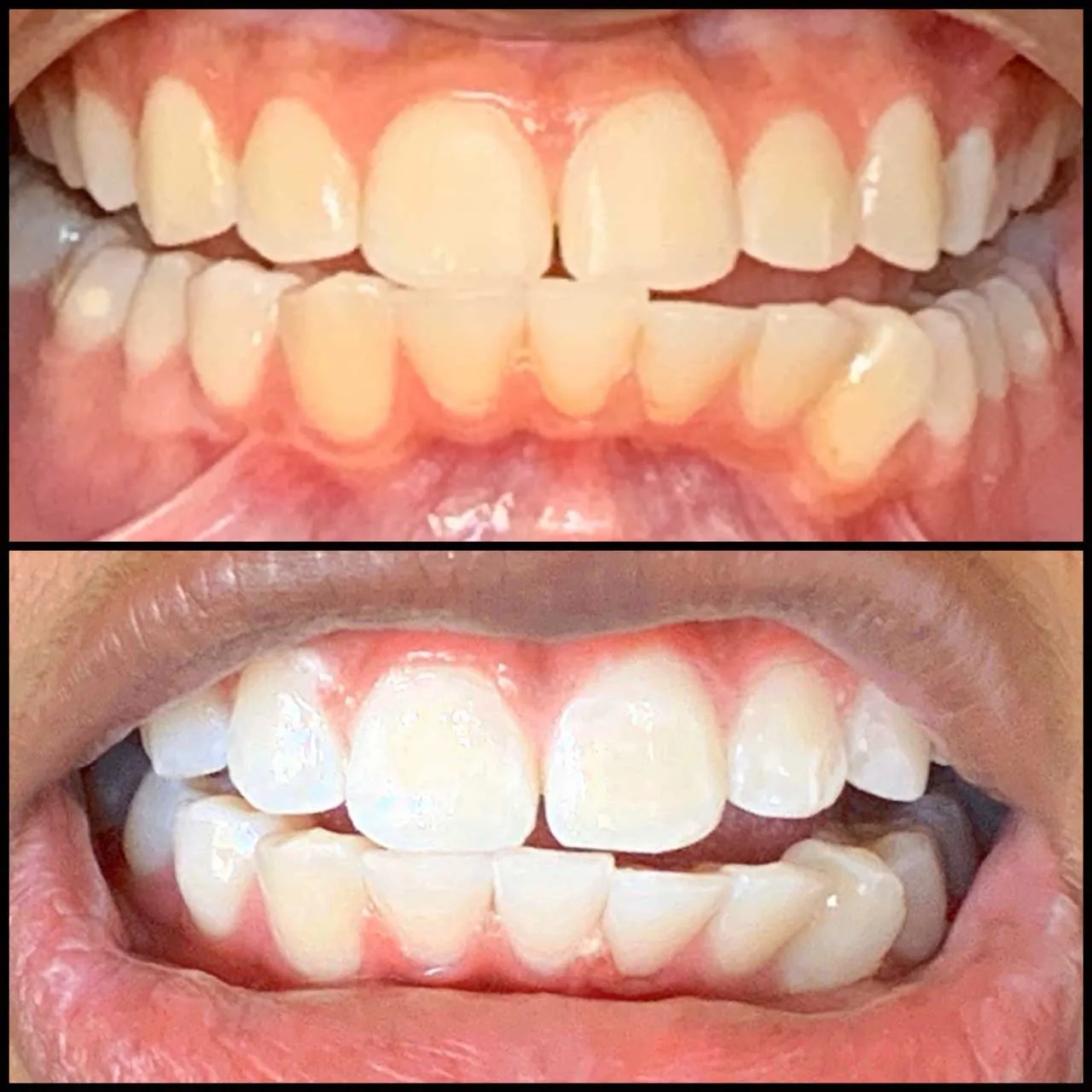 31554 teeth whitening gonzales la procedure