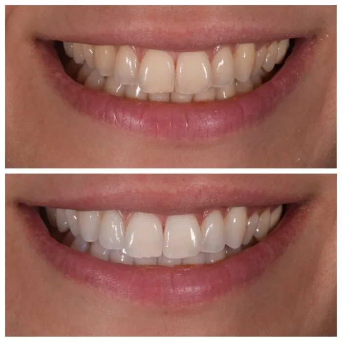 /img/31562-teeth-whitening-results.webp