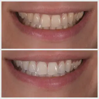 /img/31562-teeth-whitening-results.webp