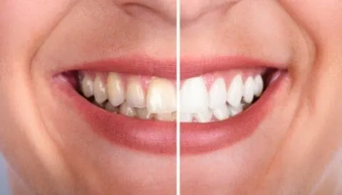 31566 teeth whitening cost
