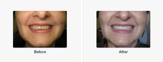 31567 teeth whitening take home kit