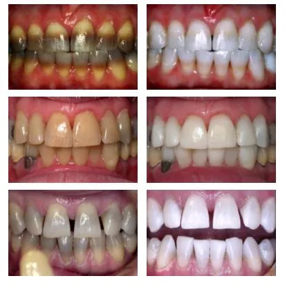 31570 kor whitening sensitive teeth image6