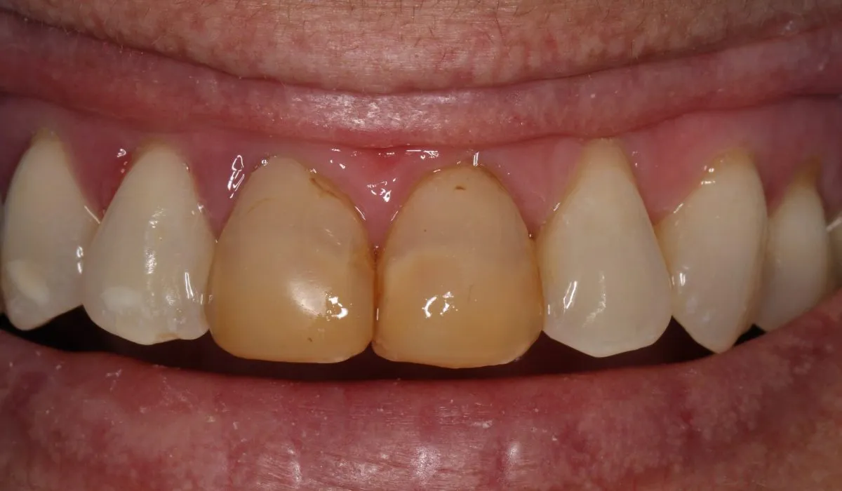 /img/31570-kor-whitening-sensitive-teeth-image7.webp