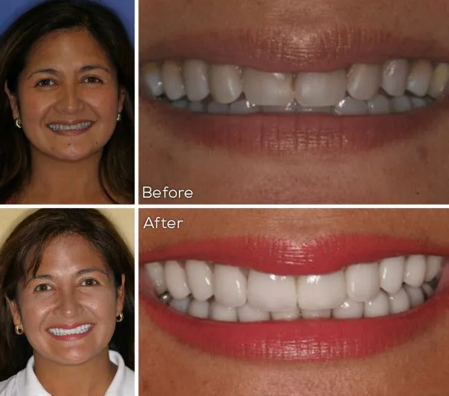 31572 teeth whitening destin fl 1